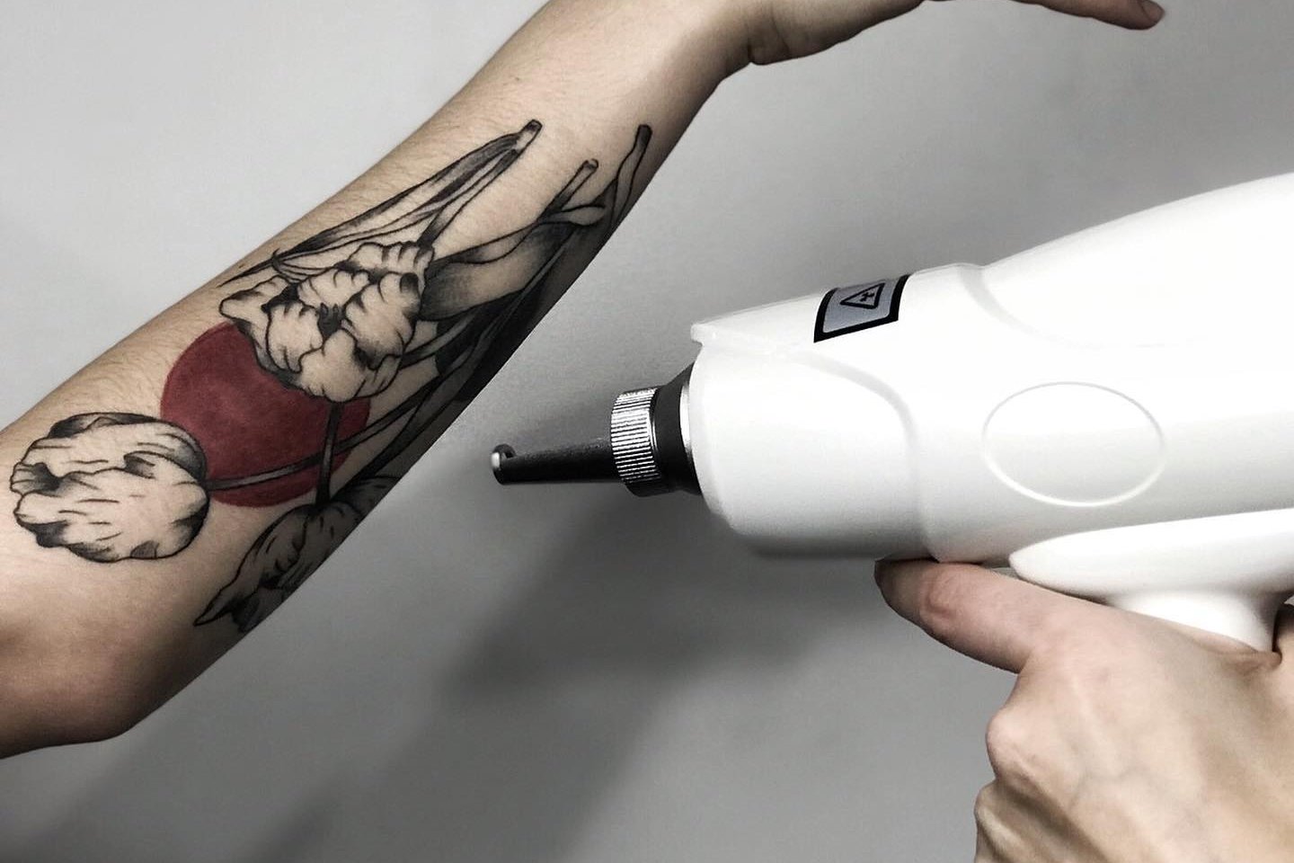 Laser tattoo removal in Košice