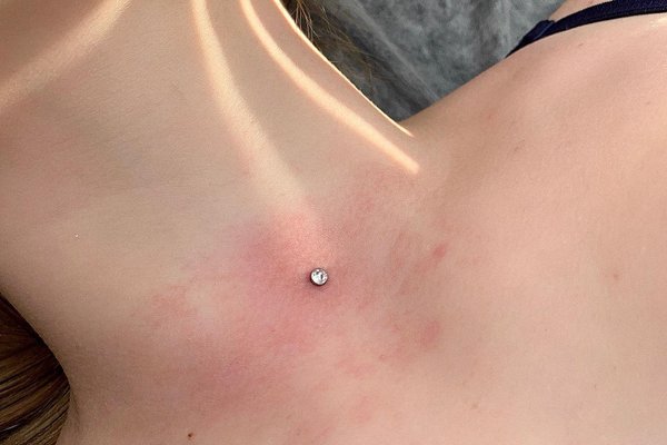 Mikrodermálny piercing